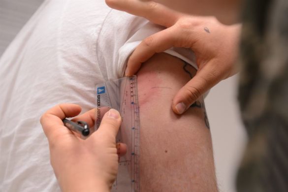 Médico medindo o inchaço no braço de uma pessoa com uma régua