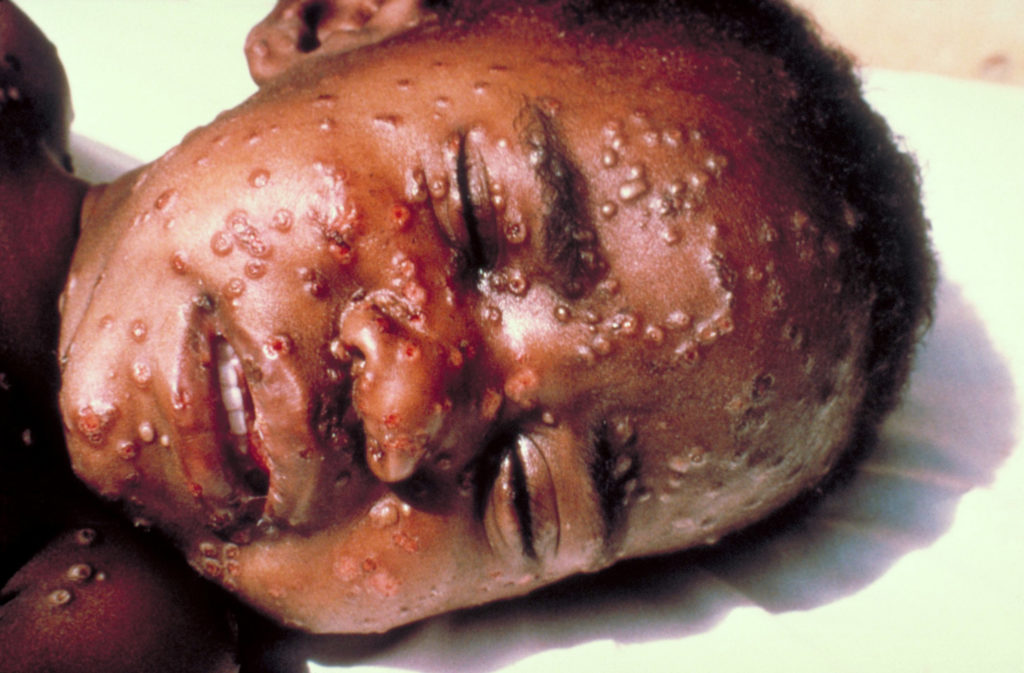 Criança em estado grave da doença da varíola