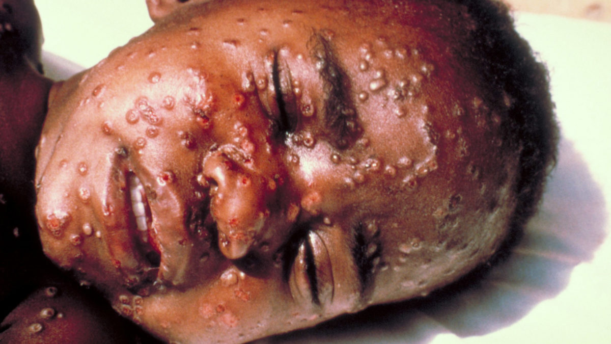 Varíola: causa, sintomas e formas de prevenção!