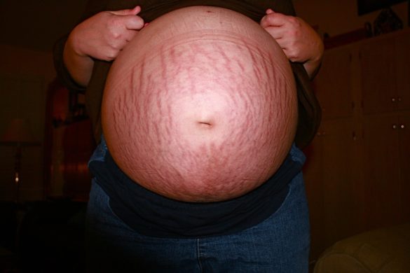 Barriga de uma mulher grávida repleta de estrias