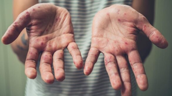 Tratamento do sarampo: imagem das mãos de uma pessoa com pintas vermelhas